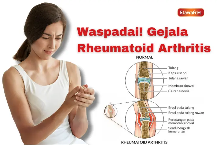 Penting Diwaspadai! Gejala Rheumatoid Arthritis, Pengobatannya